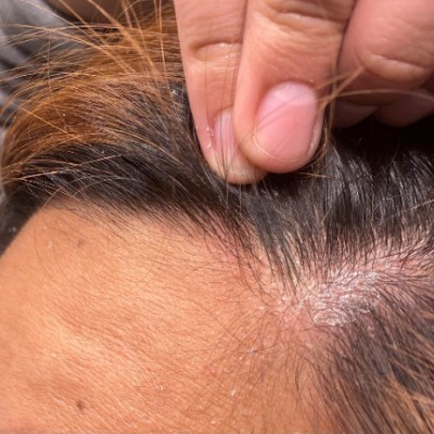 scalp-infection-causes-1.jpg